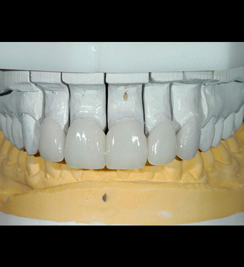 Martine's Story - Cosmetic Dentistry
