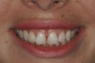 Martine's Story - Cosmetic Dentistry