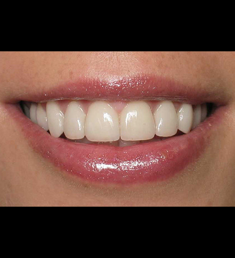Nicola's Story - Cosmetic Dentistry