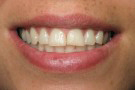 Nicola's Story - Cosmetic Dentistry