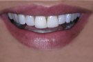 Sophie's Story - Cosmetic Dentistry