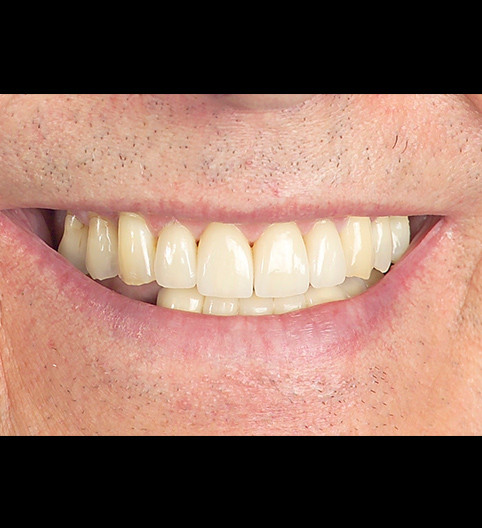 Tony's Story - Cosmetic Dentistry