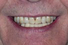 Tony's Story - Cosmetic Dentistry