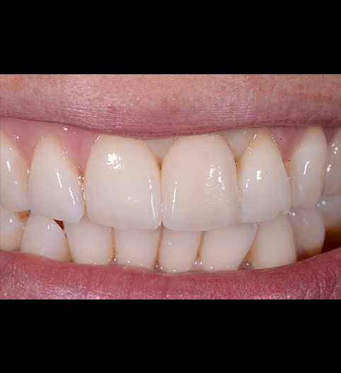 Sarah's Story - Implant Restorative