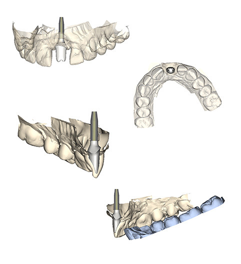 Sarah's Story - Implant Restorative