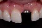 Sarah's Story - Implant Restorative