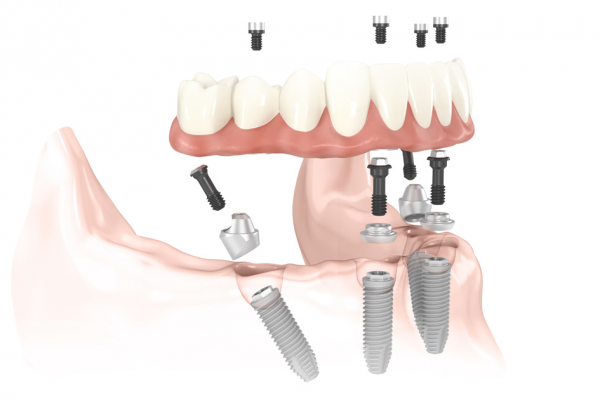 Teeth in a Day - want to know more